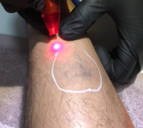Varices con L�ser